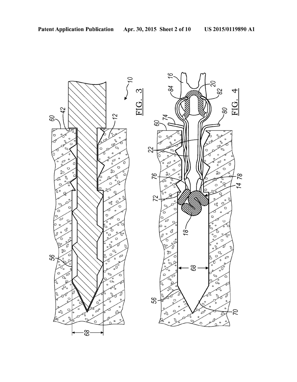 Method And Apparatus For Forming A Bone Hole - diagram, schematic, and image 03