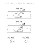 VASCULATURE CLOSURE METHODS diagram and image