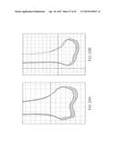 METHOD OF GENERATING A PATIENT-SPECIFIC BONE SHELL diagram and image