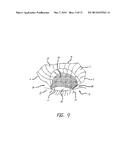 Artificial Perforated Tarsorrhaphy diagram and image