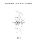 Artificial Perforated Tarsorrhaphy diagram and image