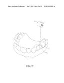 SPRING CLIP MOUNTED TO WITHDRAWABLE ARTIFICIAL TOOTH AND REMOVABLE     ARTIFICIAL TOOTH ASSEMBLED WITH SAME diagram and image