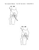 FLEXIBLE ACL INSTRUMENTATION, KIT AND METHOD diagram and image