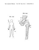 Pneumatic Surgical Instrument and Corresponding Methods for Implanting,     Extracting and Reorienting Orthopedic Implants diagram and image