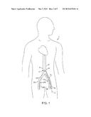 DEVICE AND METHOD FOR ESTABLISHING AN ARTIFICIAL ARTERIO-VENOUS FISTULA diagram and image