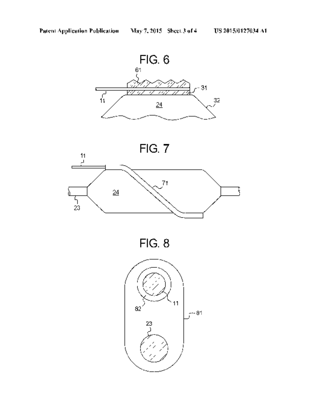 BALLOON CATHETER WITH LITHOTRIPSY AMPLIFICATION SYSTEM - diagram, schematic, and image 04