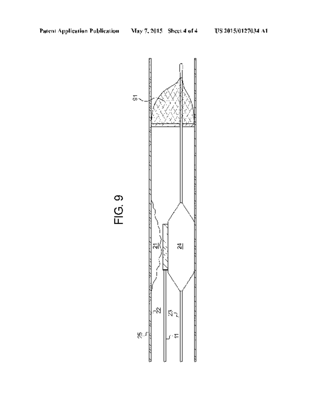 BALLOON CATHETER WITH LITHOTRIPSY AMPLIFICATION SYSTEM - diagram, schematic, and image 05