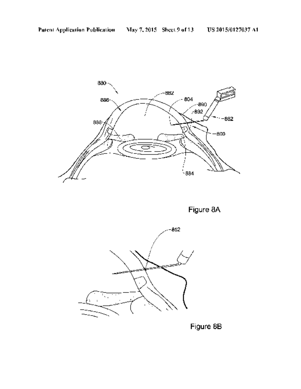 MEDICAL DEVICE, ASSEMBLY AND METHOD FOR CREATING A CHANNEL IN SOFT TISSUE - diagram, schematic, and image 10