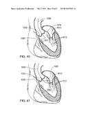 MAGNETIC RETAINING MECHANISMS FOR PROSTHETIC VALVES diagram and image