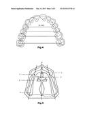 METHOD FOR PREPARING A PARTIAL OR FULL DENTAL PROSTHESIS diagram and image