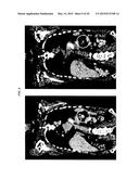 Anti-Pancreatic Cancer Antibodies diagram and image