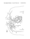 BIFURCATED OUTFLOW CANNULAE diagram and image