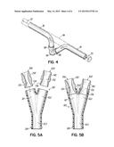 BIFURCATED OUTFLOW CANNULAE diagram and image