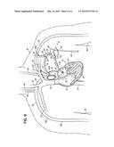 BIFURCATED OUTFLOW CANNULAE diagram and image