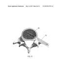 ENDOSCOPIC FUSION SYSTEM AND METHOD WITH NEUROMONITORING diagram and image