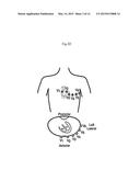 NONINVASIVE ATRIAL ACTIVITY ESTIMATION SYSTEM AND METHOD diagram and image