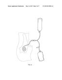 SYSTEM AND METHOD OF MONITORING AND CONTROL OF ULTRAFILTRATION VOLUME     DURING PERITONEAL DIALYSIS USING SEGMENTAL BIOIMPEDANCE diagram and image