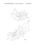 SYSTEMS AND METHODS FOR ANCHORING MEDICAL DEVICES diagram and image