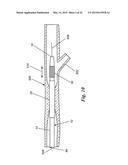 PERCUTANEOUS CATHETER-BASED ARTERIAL DENERVATION WITH INTEGRAL EMOBOLIC     FILTER diagram and image