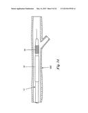 PERCUTANEOUS CATHETER-BASED ARTERIAL DENERVATION WITH INTEGRAL EMOBOLIC     FILTER diagram and image