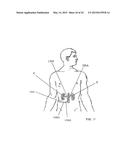 PERCUTANEOUS CATHETER-BASED ARTERIAL DENERVATION WITH INTEGRAL EMOBOLIC     FILTER diagram and image