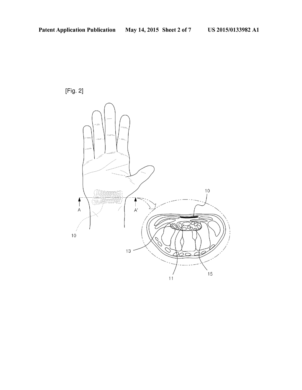 SURGICAL INSTRUMENT, AND MEDICAL KIT FOR TREATING CARPAL TUNNEL SYNDROME - diagram, schematic, and image 03