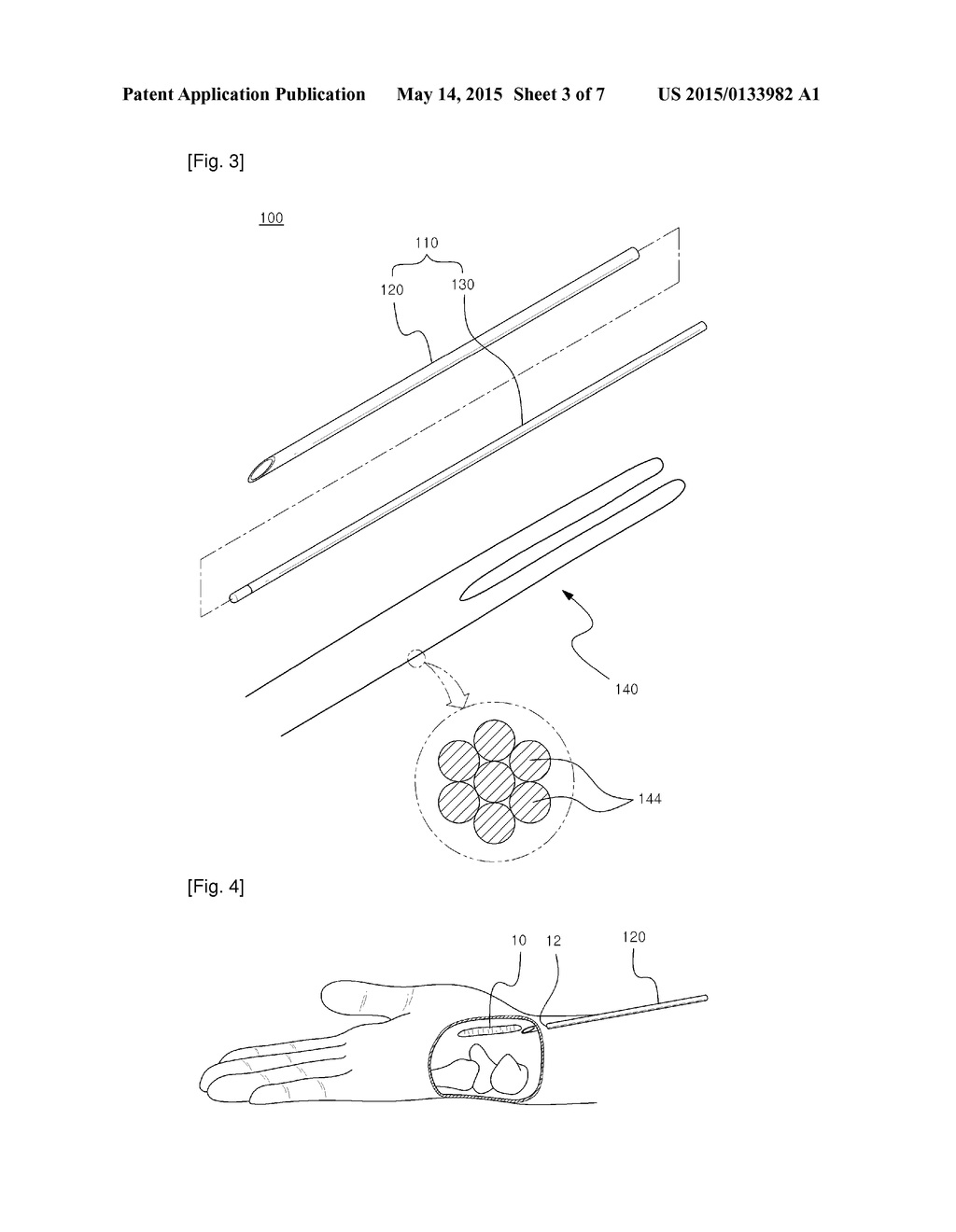 SURGICAL INSTRUMENT, AND MEDICAL KIT FOR TREATING CARPAL TUNNEL SYNDROME - diagram, schematic, and image 04