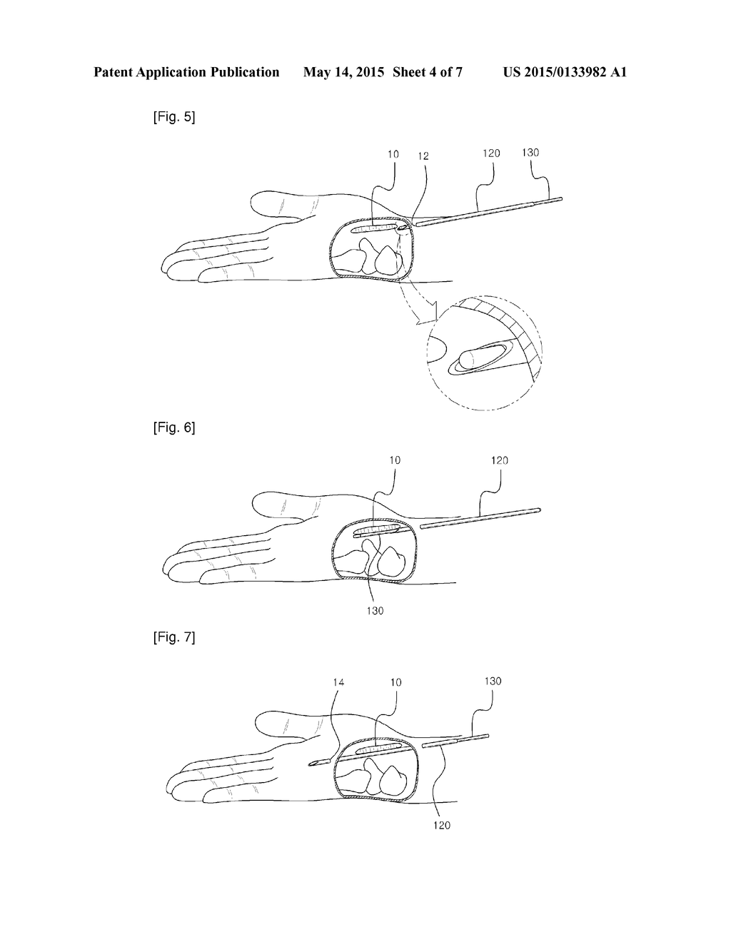 SURGICAL INSTRUMENT, AND MEDICAL KIT FOR TREATING CARPAL TUNNEL SYNDROME - diagram, schematic, and image 05