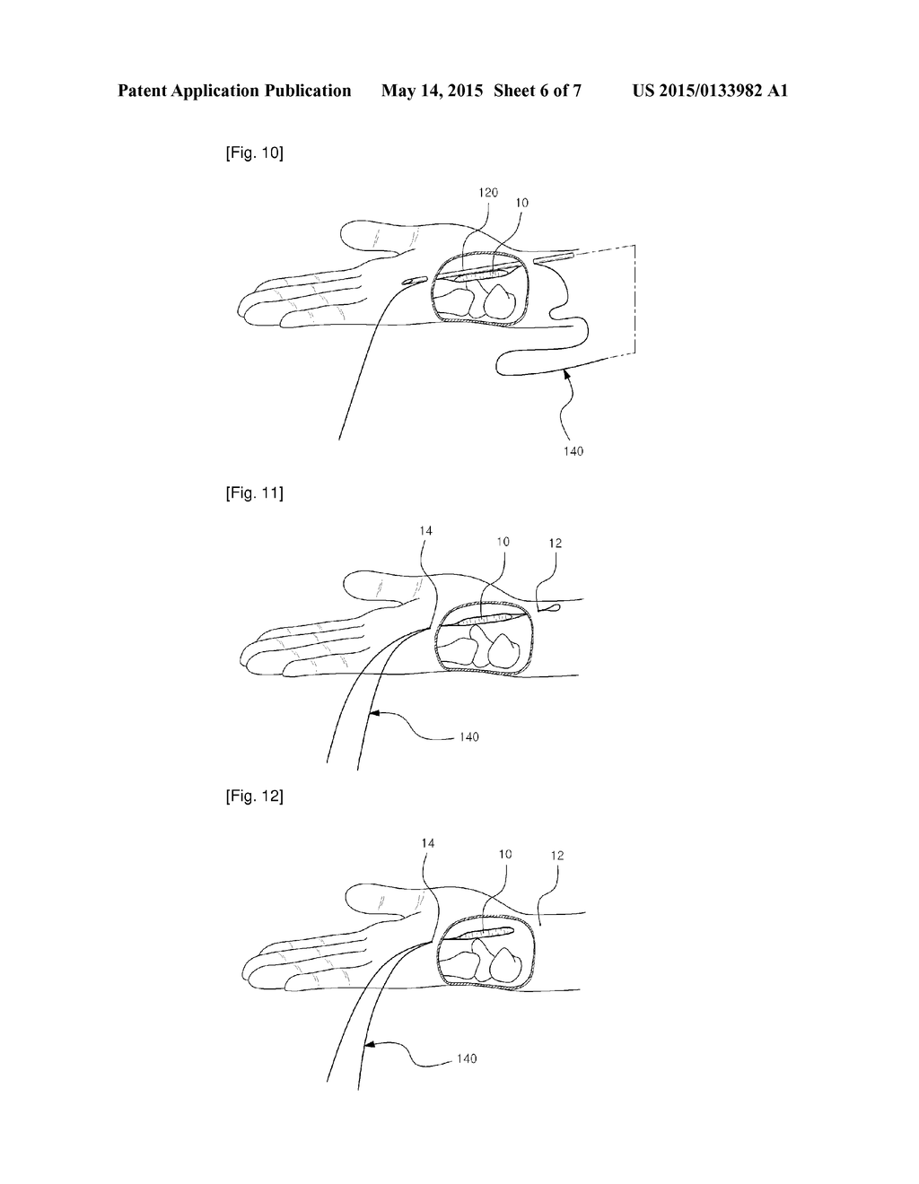 SURGICAL INSTRUMENT, AND MEDICAL KIT FOR TREATING CARPAL TUNNEL SYNDROME - diagram, schematic, and image 07