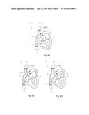 EXPANDABLE OCCLUSION DEVICES AND METHODS OF USE diagram and image