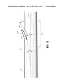 Compound Barb Medical Device and Method diagram and image