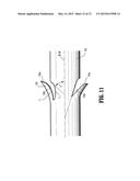 Compound Barb Medical Device and Method diagram and image