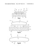 METHOD OF FIXATING TWO OR MORE ANATOMICAL BODIES diagram and image