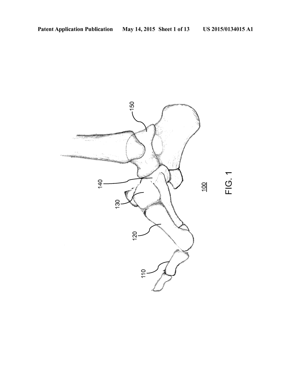 DEVICES AND METHODS FOR BONE FIXATION USING AXIAL IMPLANTS - diagram, schematic, and image 02