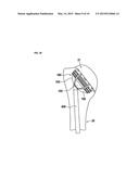 SHOULDER IMPLANT WITH STEM diagram and image