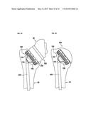 SHOULDER IMPLANT WITH STEM diagram and image