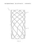 ENDOLUMINAL DEVICE diagram and image