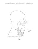 Tracheostomy Tube With Inner Cannula diagram and image