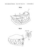 CLEAR ALIGNER AND MANUFACTURING METHOD THEREOF, TRACTION DEVICE FOR CLEAR     ALIGNER, AND AID FOR TRACTION DEVICE FOR CLEAR ALIGNER diagram and image