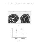 INDANE DIMERS FOR USE IN THE TREATMENT OF AUTOIMMUNE INFLAMMATORY DISEASE diagram and image