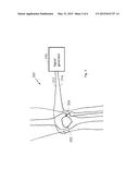 METHOD AND DEVICE FOR TREATING OSTEOARTHRITIS NONINVASIVELY diagram and image