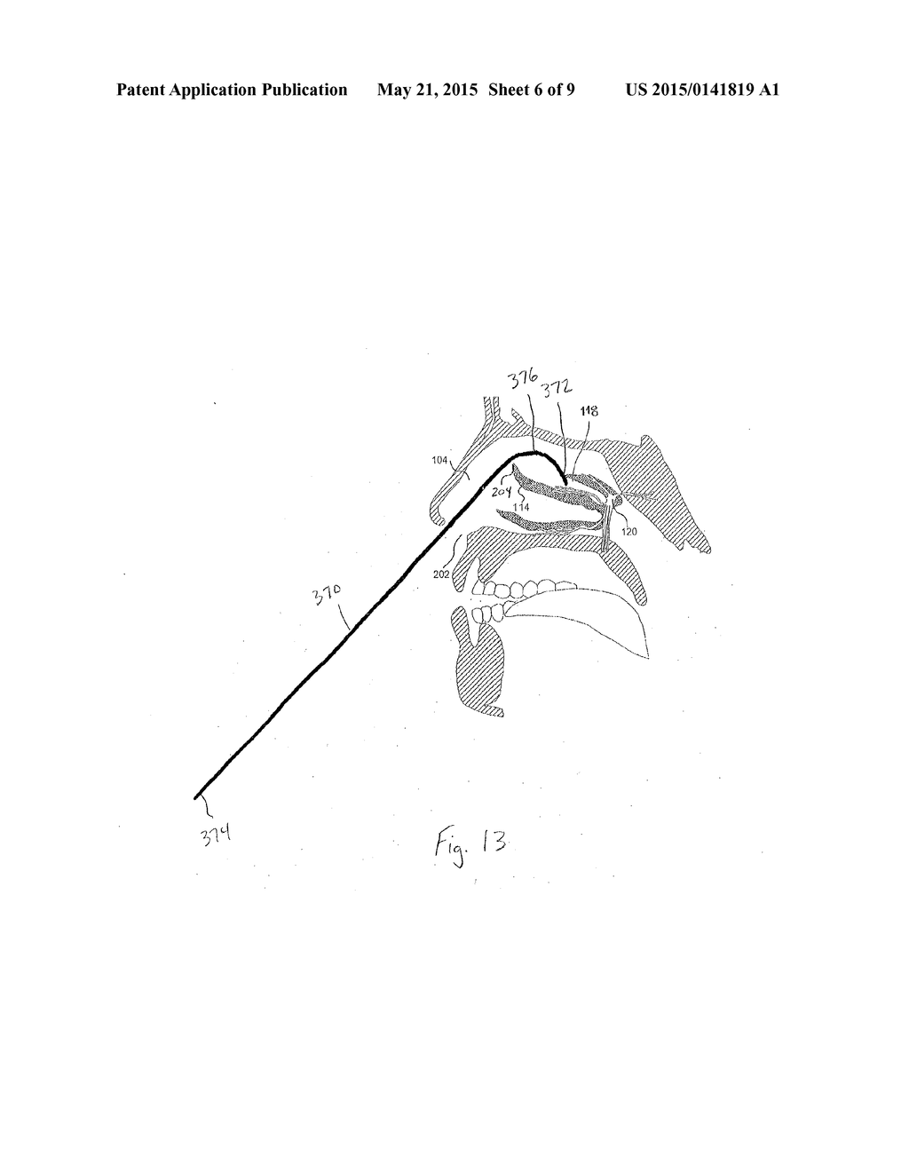 SYSTEM AND METHOD FOR FACILITATING INTRANASAL GUIDANCE - diagram, schematic, and image 07