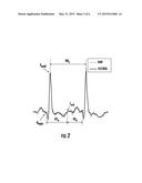 NOVEL METHODOLOGY FOR ASSESSING THE BOUNDED-INPUT BOUNDED-OUTPUT     INSTABILITY IN QT INTERVAL DYNAMICS: APPLICATION TO CLINICAL ECG WITH     VENTRICULAR TACHYCARDIA diagram and image