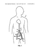 DEVICE AND METHOD FOR ESTABLISHING AN ARTIFICIAL ARTERIO-VENOUS FISTULA diagram and image