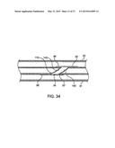 DEVICE AND METHOD FOR ESTABLISHING AN ARTIFICIAL ARTERIO-VENOUS FISTULA diagram and image