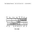 DEVICE AND METHOD FOR ESTABLISHING AN ARTIFICIAL ARTERIO-VENOUS FISTULA diagram and image