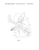 Devices, Systems, Methods and Kits for Performing Selective Dissection of     Lung Tissue diagram and image