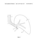 Devices, Systems, Methods and Kits for Performing Selective Dissection of     Lung Tissue diagram and image