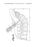 SPINAL FIXATION TOOL ATTACHMENT STRUCTURE diagram and image