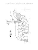 SPINAL FIXATION TOOL ATTACHMENT STRUCTURE diagram and image